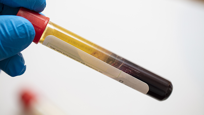 platelet rich plasma