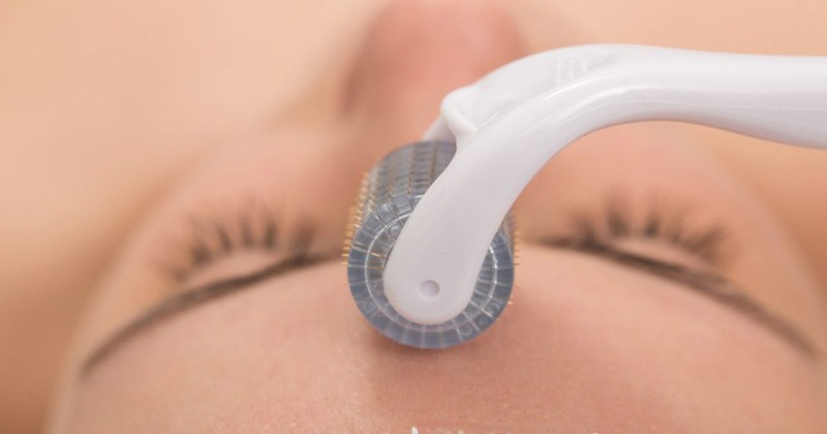 Microneedling