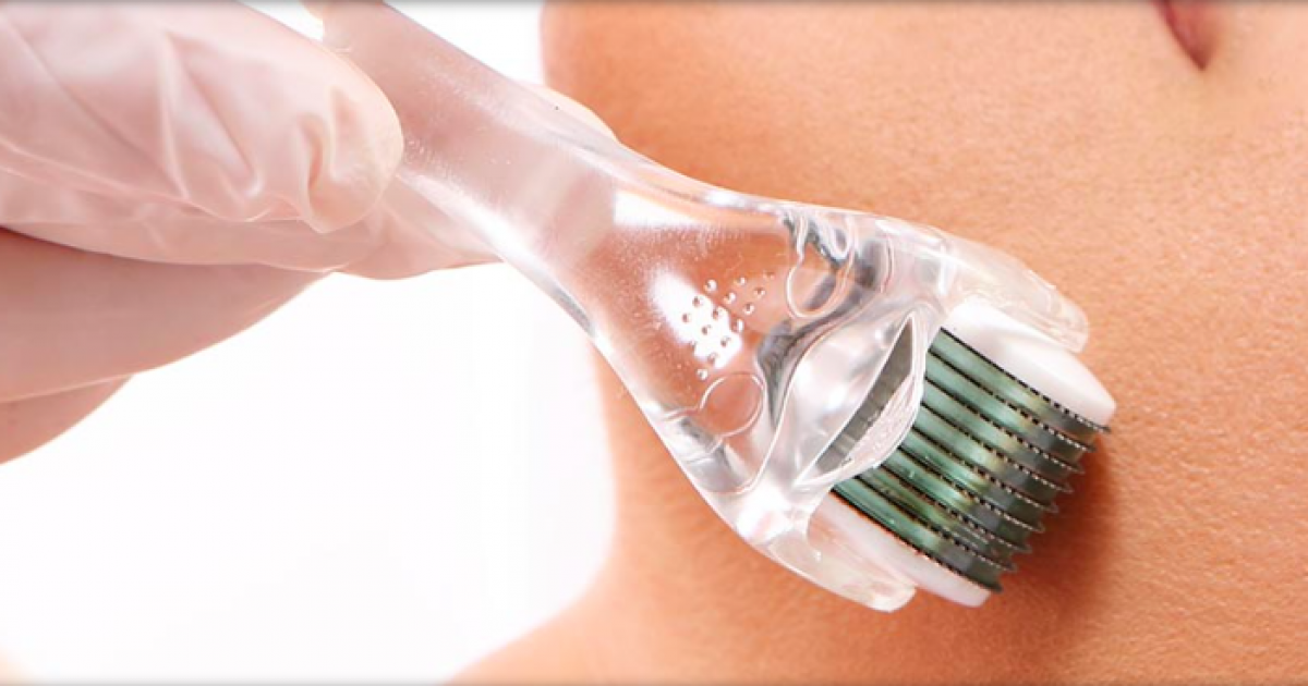Microneedling